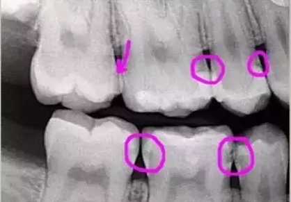 看牙齒為什么要拍片？