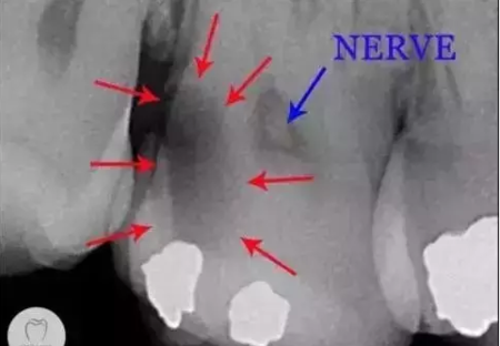 看牙齒為什么要拍片？