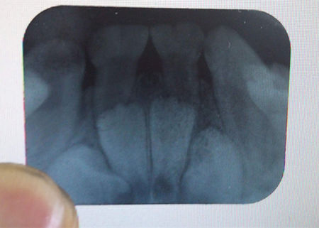 看牙齒為什么要拍片？