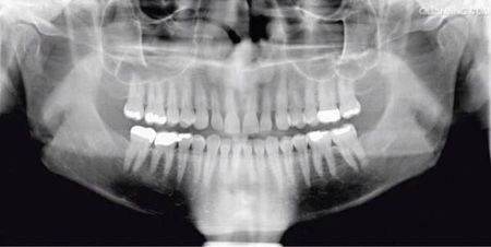 看牙齒為什么要拍片？